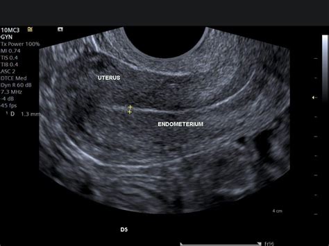 An ultrasound pelvis scan is a non.